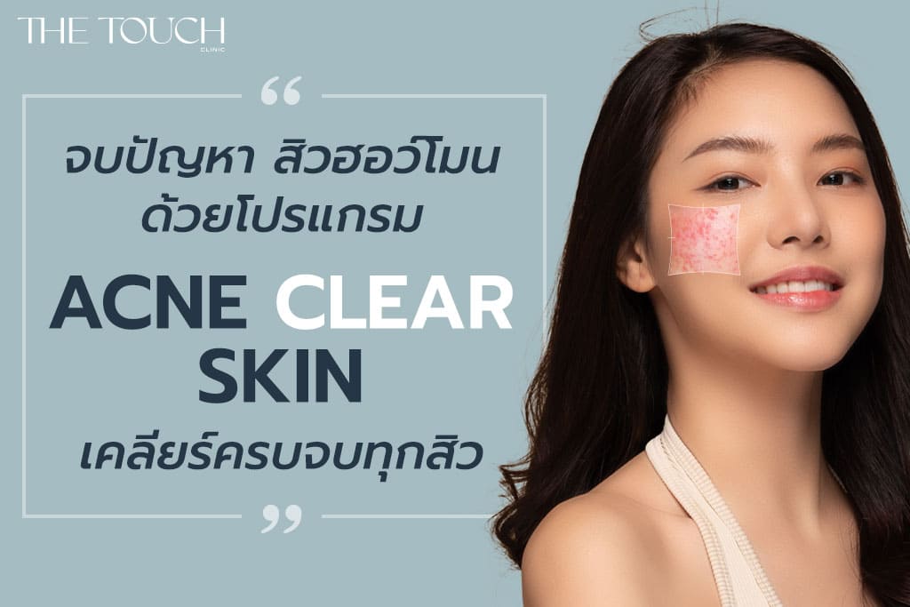 ฮอร์โมนไม่สมดุล ปัญหาจากภายใน สาเหตุของการเกิดสิว ที่ไม่ควรมองข้าม The  Touch Exclusive