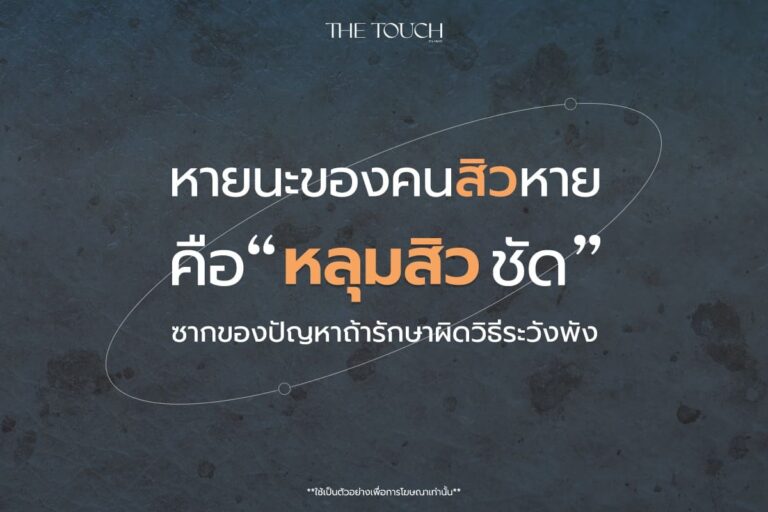 ปัญหาหลุมสิว ความท้าทายของผิวที่ไม่เพียงจบแค่การรักษาสิว